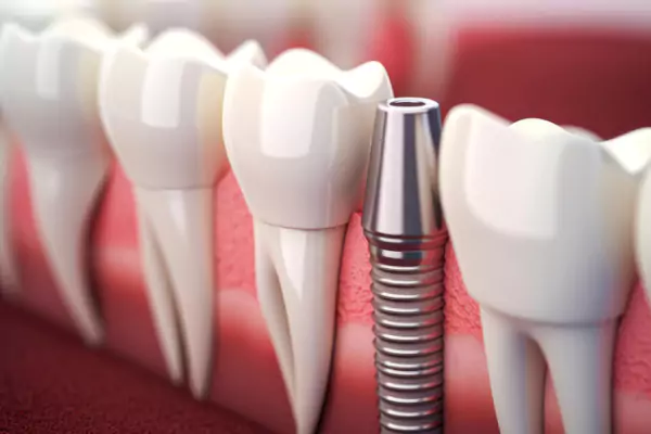 Root Canal Treatment